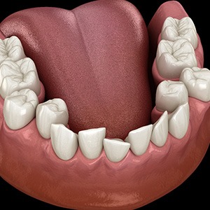Illustration of crowded teeth