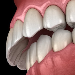 Illustration of an overbite