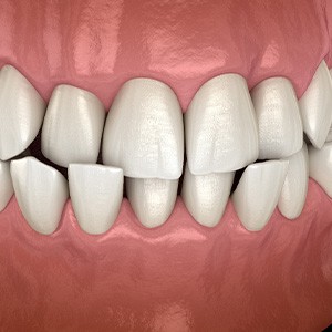 Illustration of a crossbite