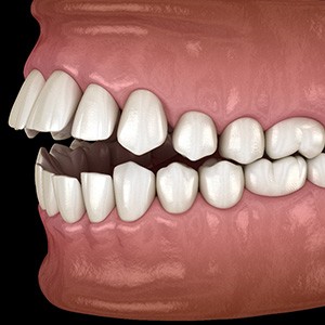 Illustration of an open bite