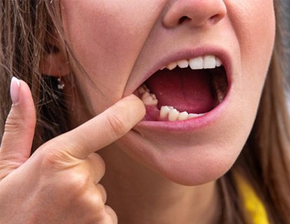 Woman pulling back her lip to reveal missing tooth