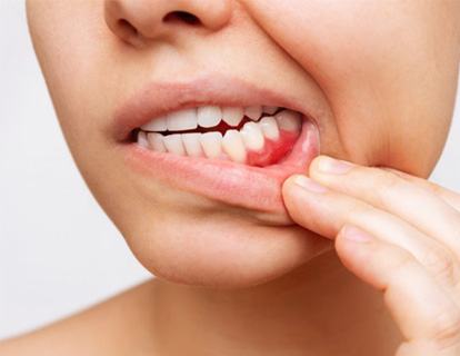 Woman pulling back her lip to reveal bleeding gums