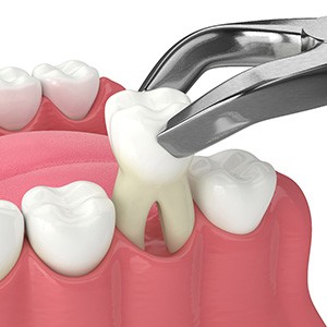 Illustration of tooth being extracted