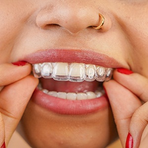 Closeup of patient putting on clear aligner
