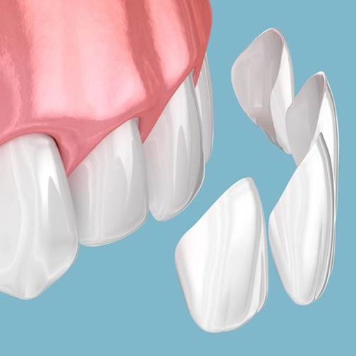 Up-close view of dental veneers