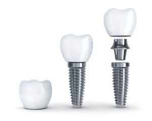 Dental Implant Springfield & Longmeadow, MA