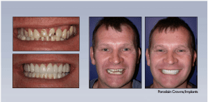 Dental Crown Implant Springfield MA
