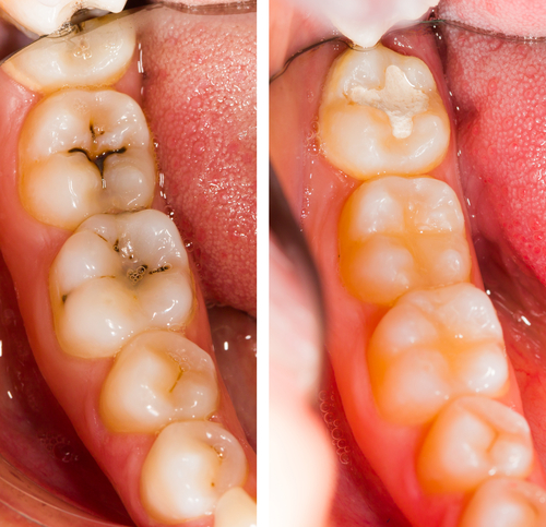 patient's bottom teeth before and after cavities filled with tooth-colored composite resin