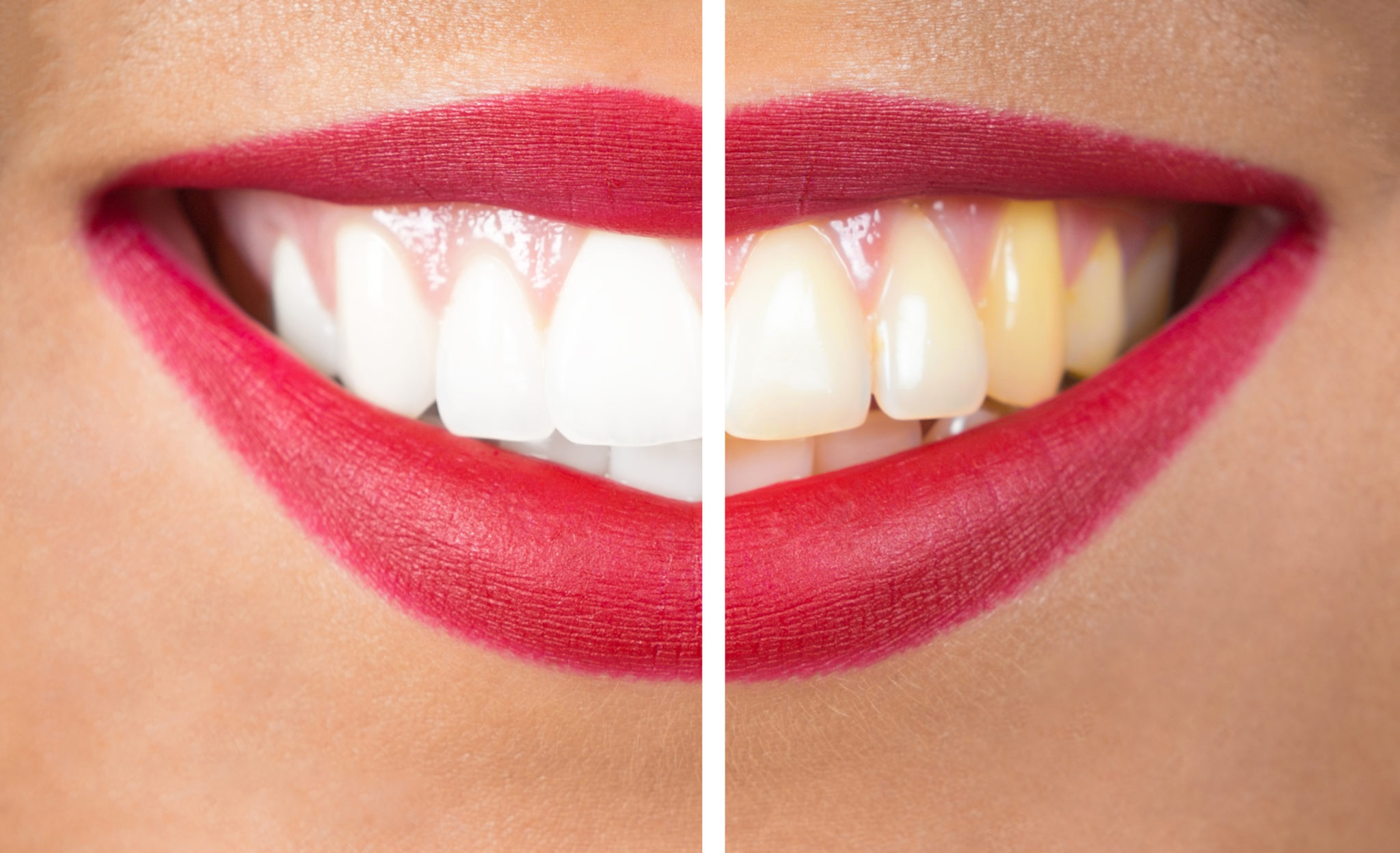before and after photo of teeth whitening, close up of woman's mouth