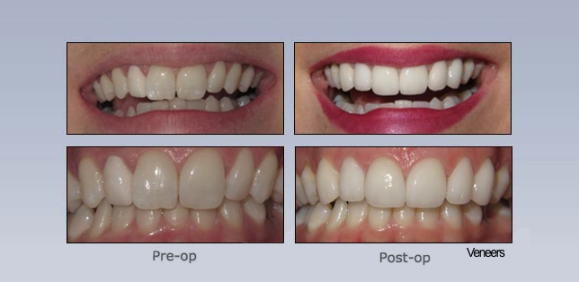 before and after of close up of woman's mouth after receiving porcelain veneers