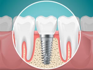Dental Implant Springfield & Longmeadow, MA